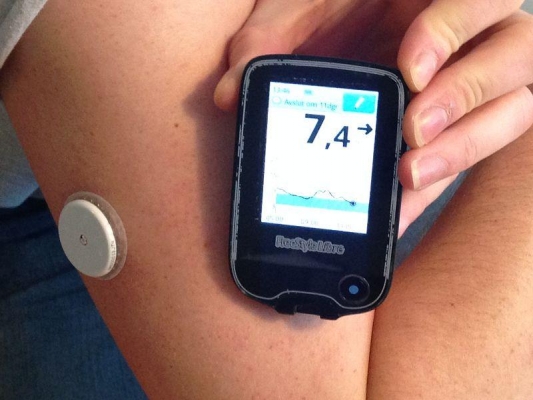 В Удмуртии детей с диабетом обеспечат датчиками непрерывного мониторирования сахара крови