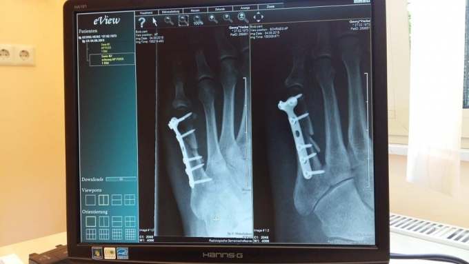14 рентгеновских аппаратов закупят в Удмуртии в 2020 году